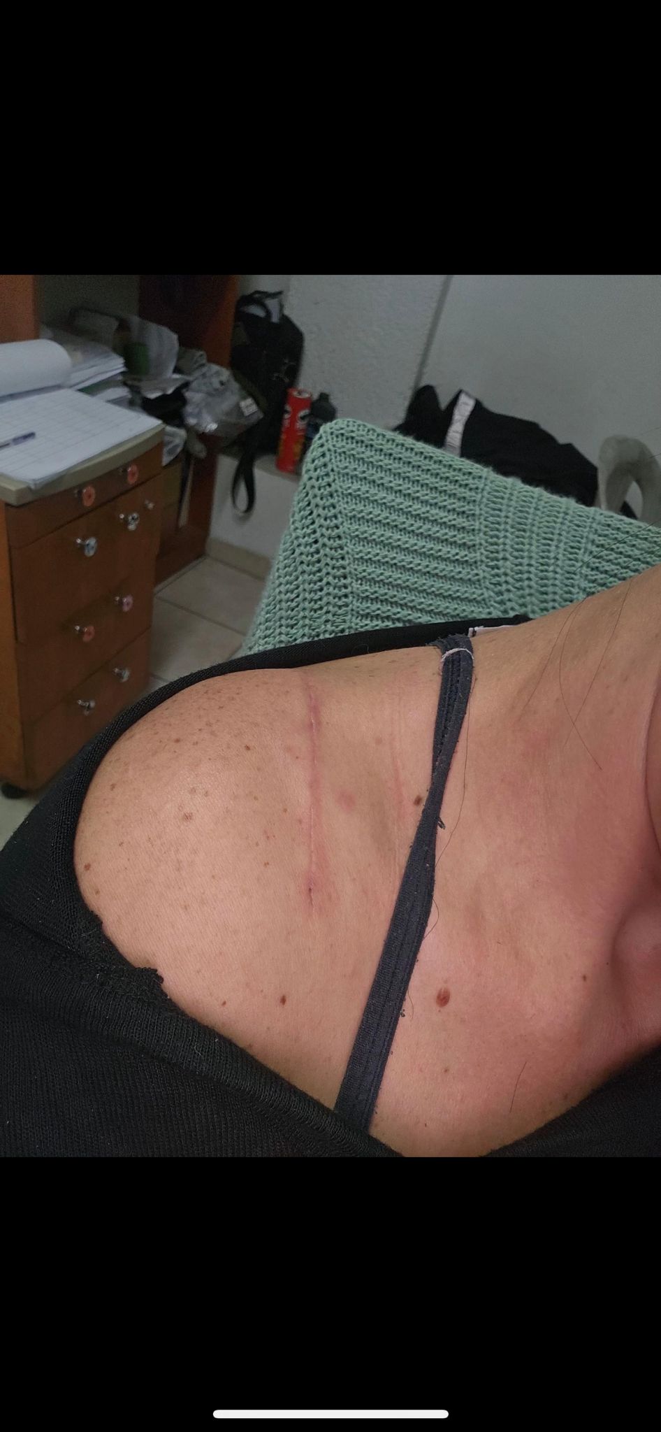Scar after Biovelvet