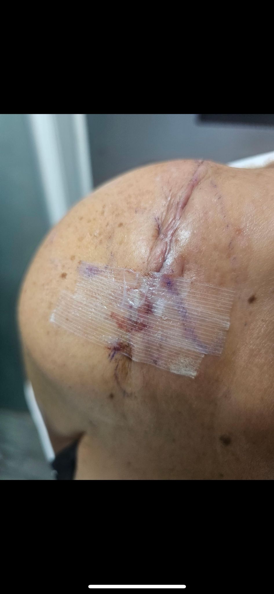 Scar before Biovelvet
